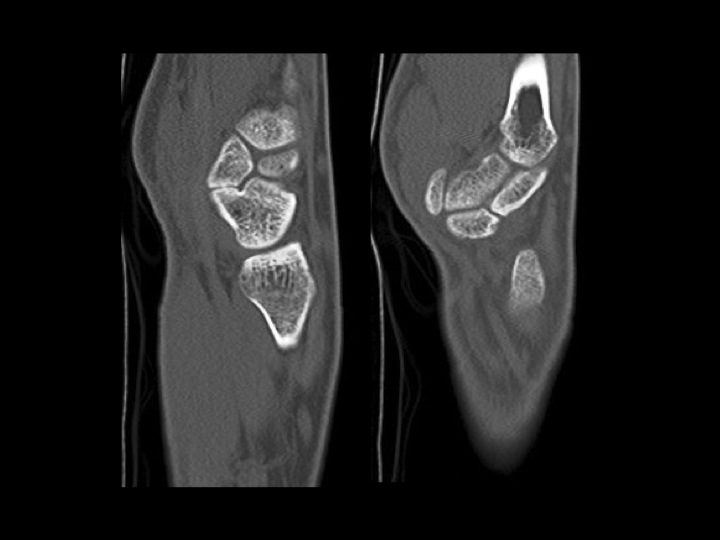 Figure 3 for case scaphotrapezoidal joint ( RID2254 )